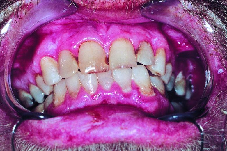 Free stock image of Bad Teeth created by Bjorgvin