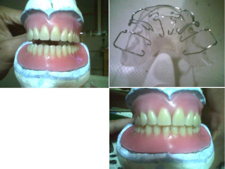 Free stock image of Dental prosthesis created by chakomajaw