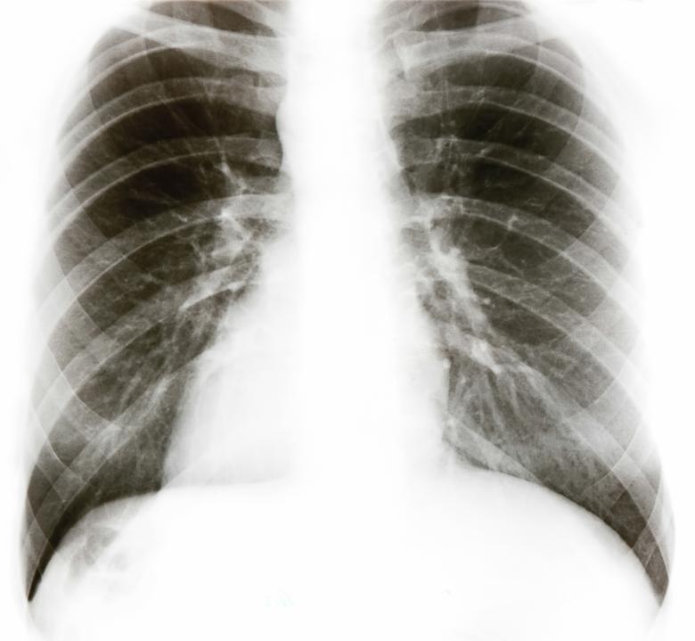 Free stock image of Xray of Chest created by 2happy