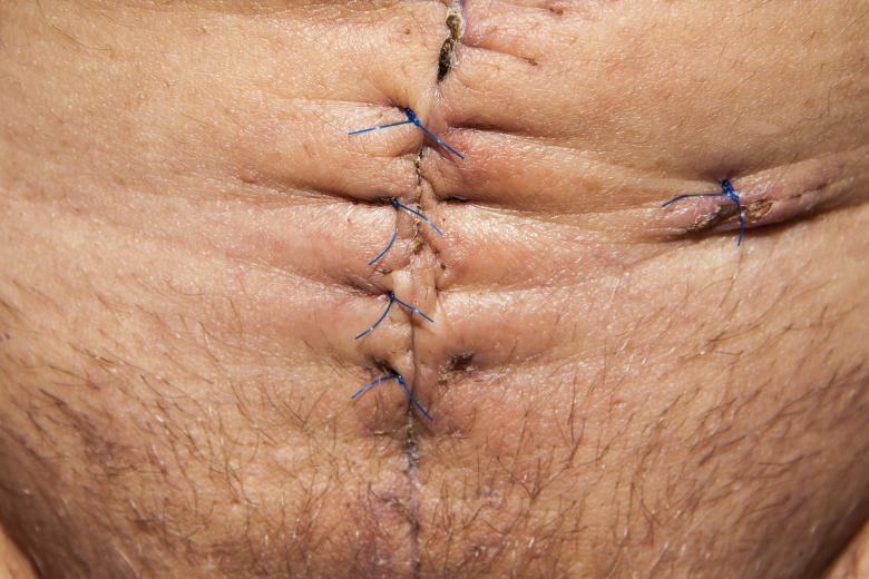 Free stock image of Stitched Stomach created by Pixabay
