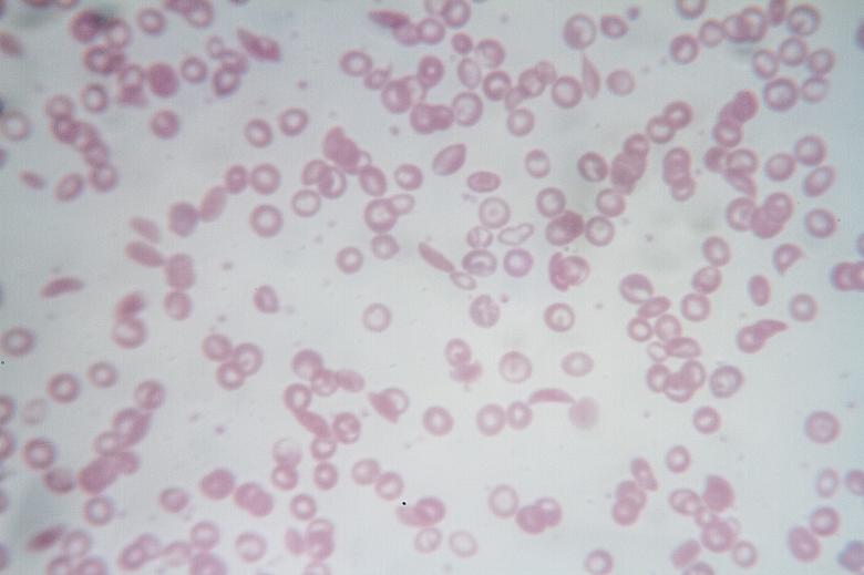 Free stock image of Sickle cell anemia created by Geoffrey Whiteway